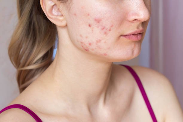 Acne Scar Treatment in Riyadh