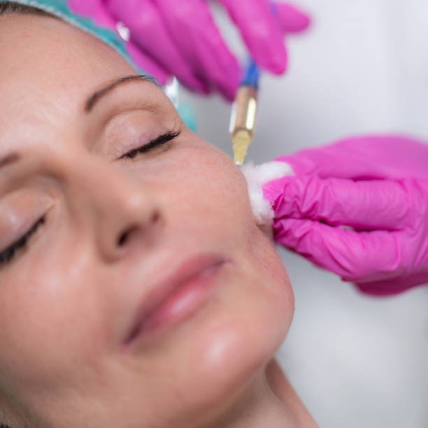 Cheek Filler Injections in Dubai