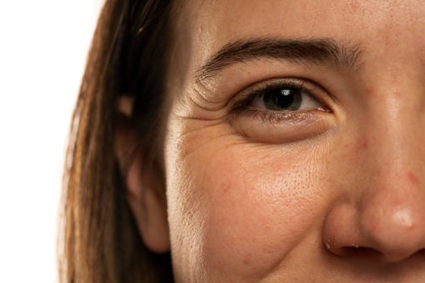 Eye bag removal in Riyadh