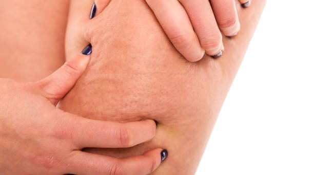 lipedema in riyadh