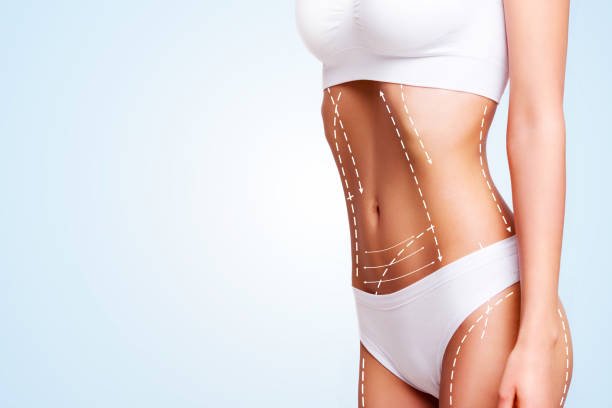 Liposuction in Riyadh