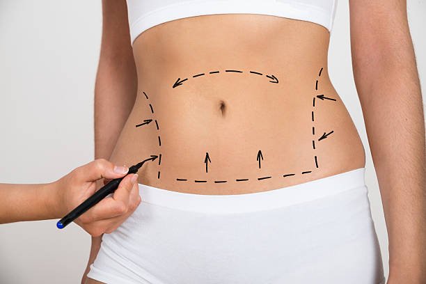 Tummy Tuck in Riyadh