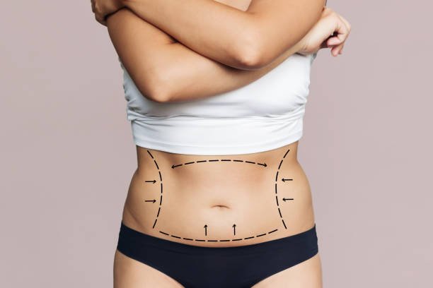 Mommy Makeover in Riyadh