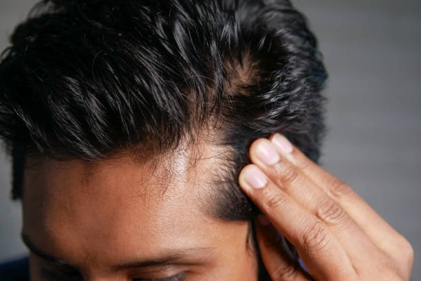PRP Hair Treatment in Riyadh