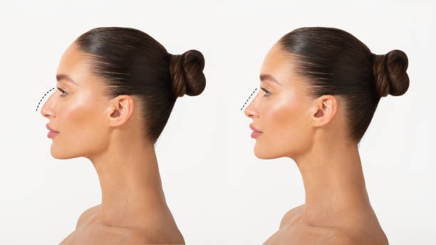 Rhinoplasty offer in Riyadh