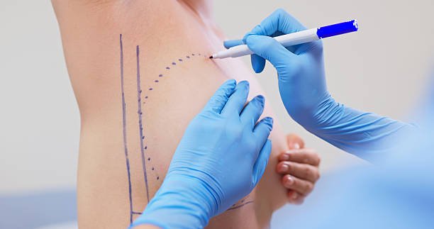 Silicone Breast Implants in Riyadh