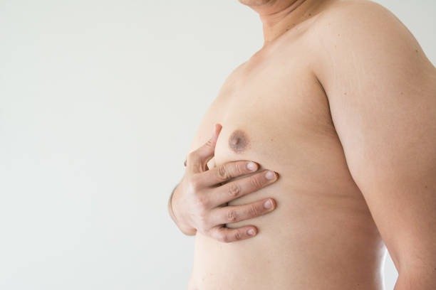 Gynecomastia Surgery in Riyadh