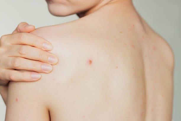 Back acne treatment
