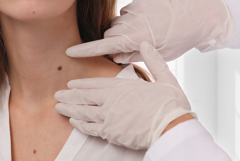 Could Skin Tag Removal Restore a Smoother Look?
