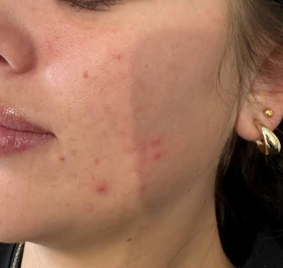Laser acne scar treatment in Riyadh