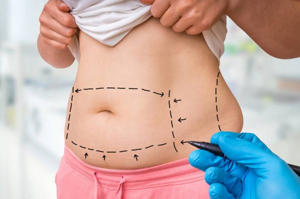 Fat Melting Injections in Riyadh