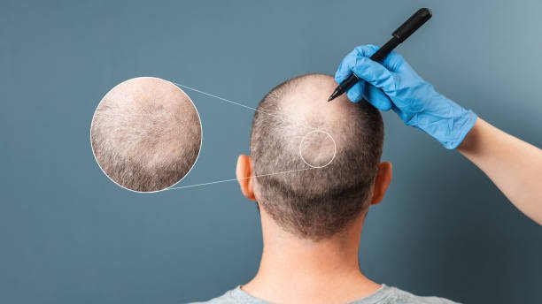 Hybrid Hair Transplant in Dubai