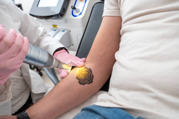 Laser Tattoo Removal in Riyadh