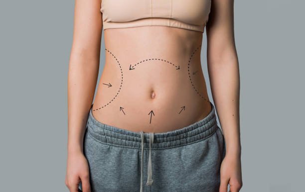 Liposuction in Riyadh