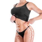 Liposuction Treatment Journey: Preparation, Procedure, Healing, and Results