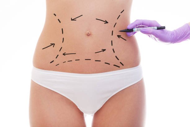 Liposuction in Riyadh