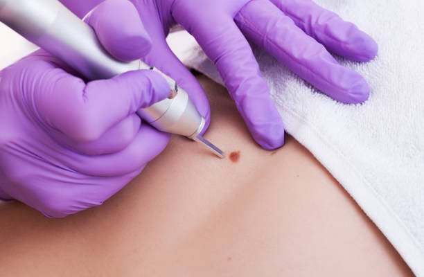 Mole Removal in Dubai