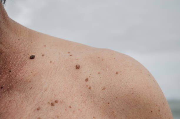 Signs Your Mole Might Need Removal for Health Reasons
