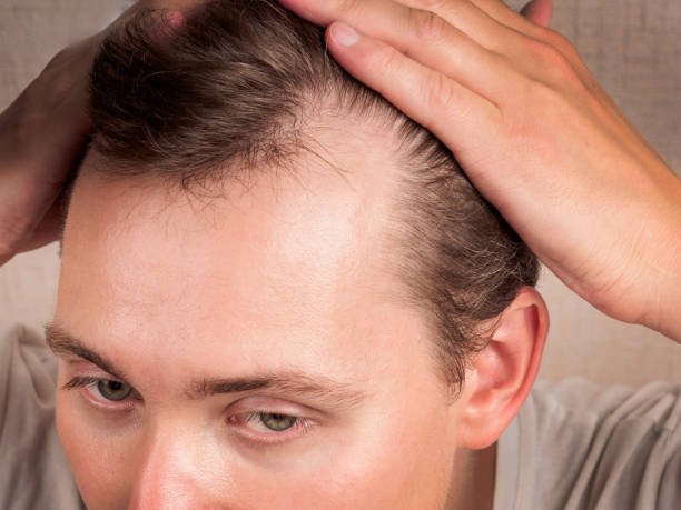PRP Hair Treatment in Riyadh