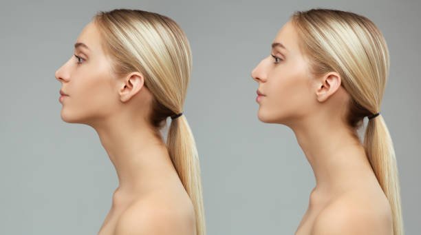 rhinoplasty in riyadh