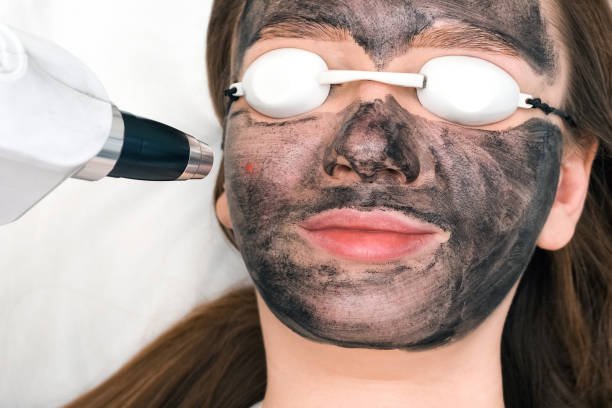 Spectra Laser Carbon Peel In Riyadh