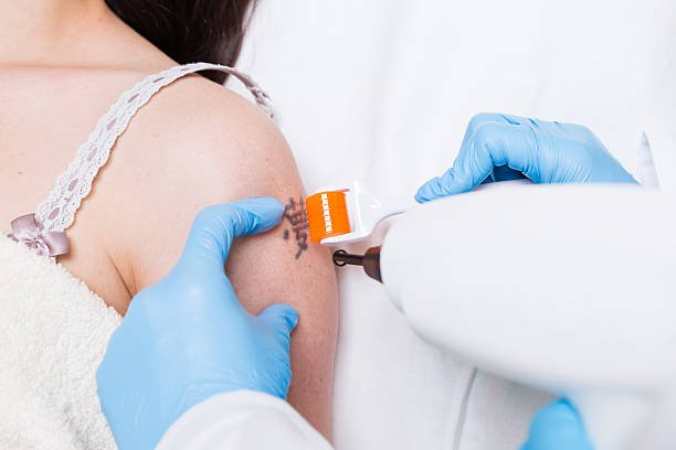 Tattoo Removal in Dubai