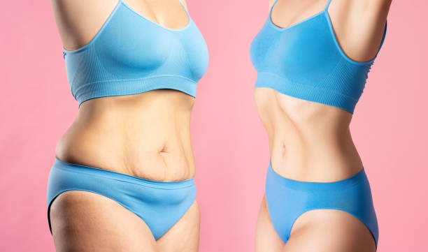 Tummy Tuck in Riyadh