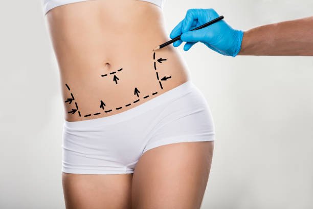 My Experience With Tummy Tuck Surgery in Riyadh