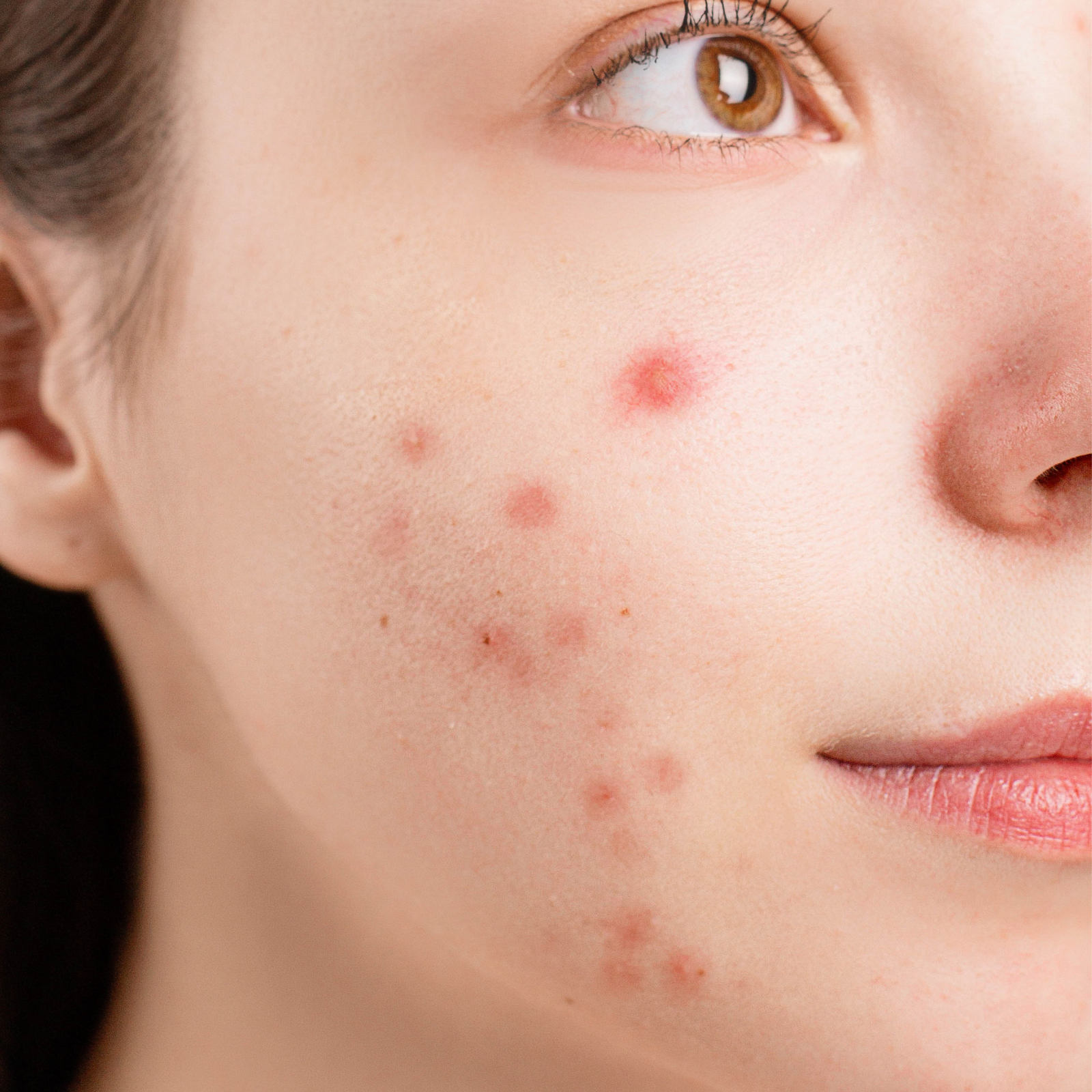 Acne Scars Removal in Roorkee