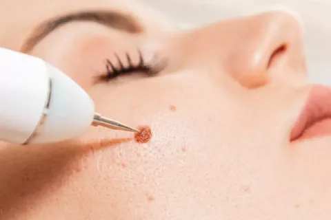Skin Wart Removal in Riyadh