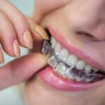 invisalign cost singapore