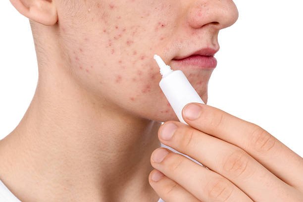 acne treatment in riyadh