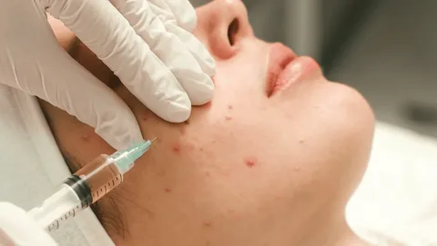 Laser Acne Scar Treatments in Riyadh