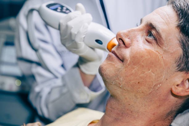 Can Pico Laser Treatment Help With Melasma