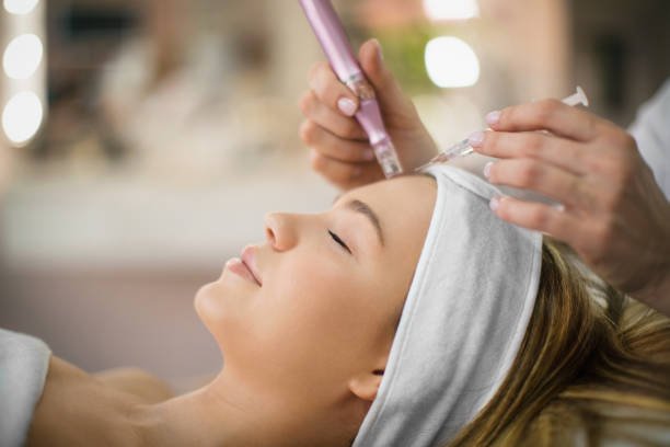 Can RF Microneedling Improve Stubborn Acne Scar Texture