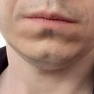 Chin dimple in Riyadh
