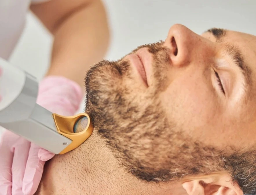 Does Beard Laser Hair Removal Ease Daily Shaving