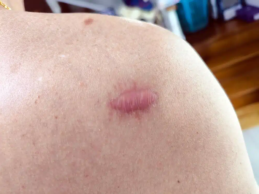 Keloid Treatment Abu Dhabi