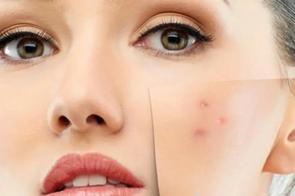 Laser Acne Scar treatment Abu Dhabi