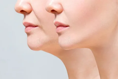 Double chin liposuction in Riyadh