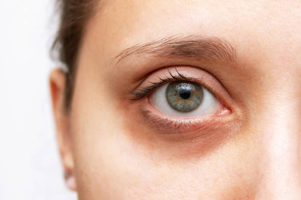 EYE BAG Removal in Riyadh