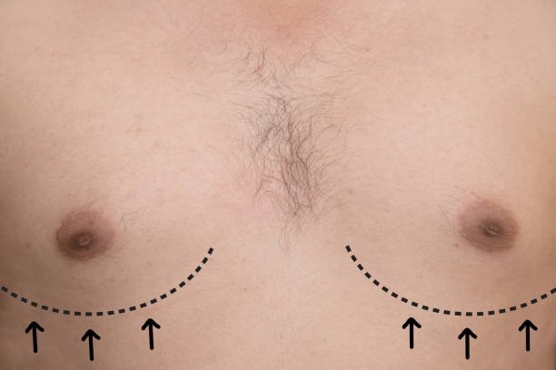 Gynecomastia surgery in Riyadh