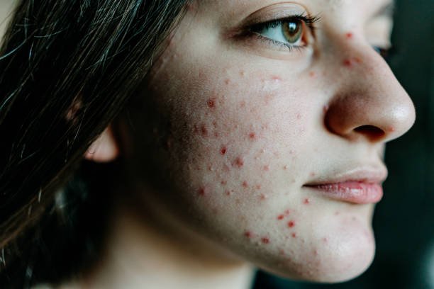 How Can Acne Treatment Address Blackhead Formation
