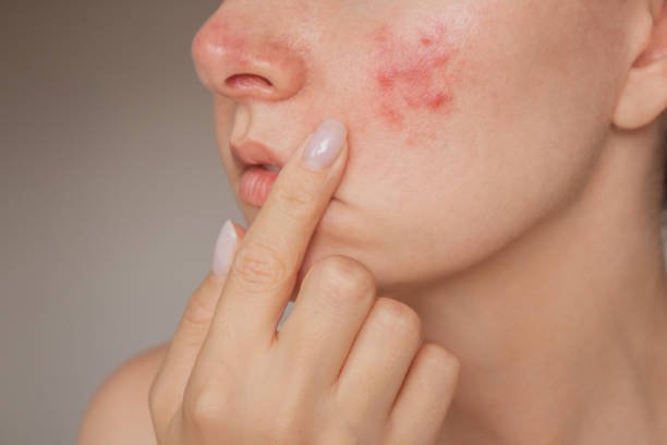How Does Acne Treatment Help Clear Skin