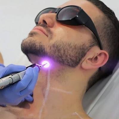 How Does Beard Laser Hair Removal Work