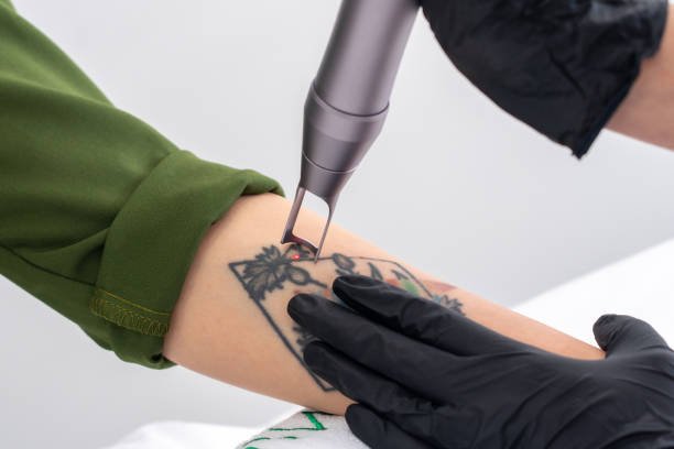 How Does Laser Tattoo Removal Fade Ink