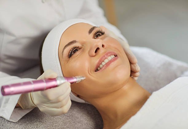 How Does Microneedling Help With Stretch Marks