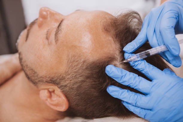 How Does PRP Treatment Improve Hair Growth