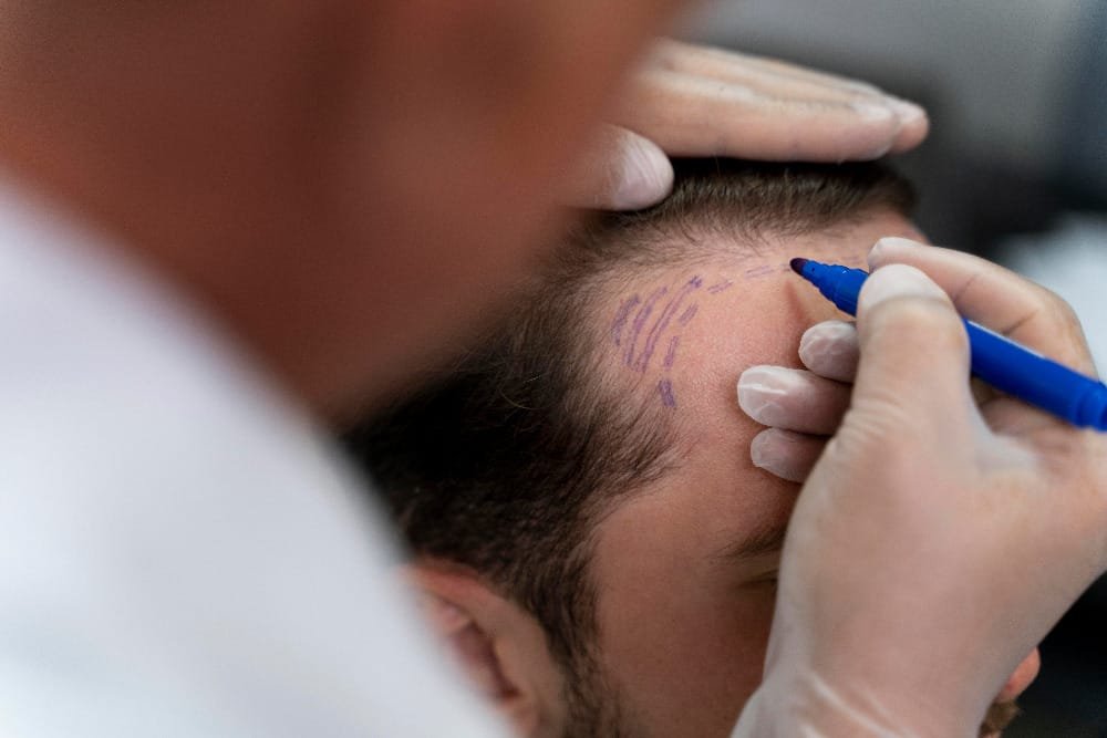DHI Direct Hair Implant in Abu Dhabi