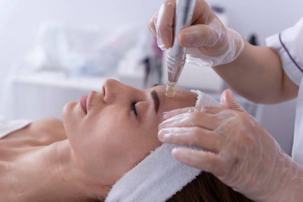 Is Fractional RF Micro Needling Suitable for All Skin Types
